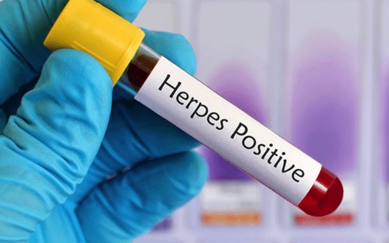 Do I Have Herpes? Common Symptoms of Genital Herpes
